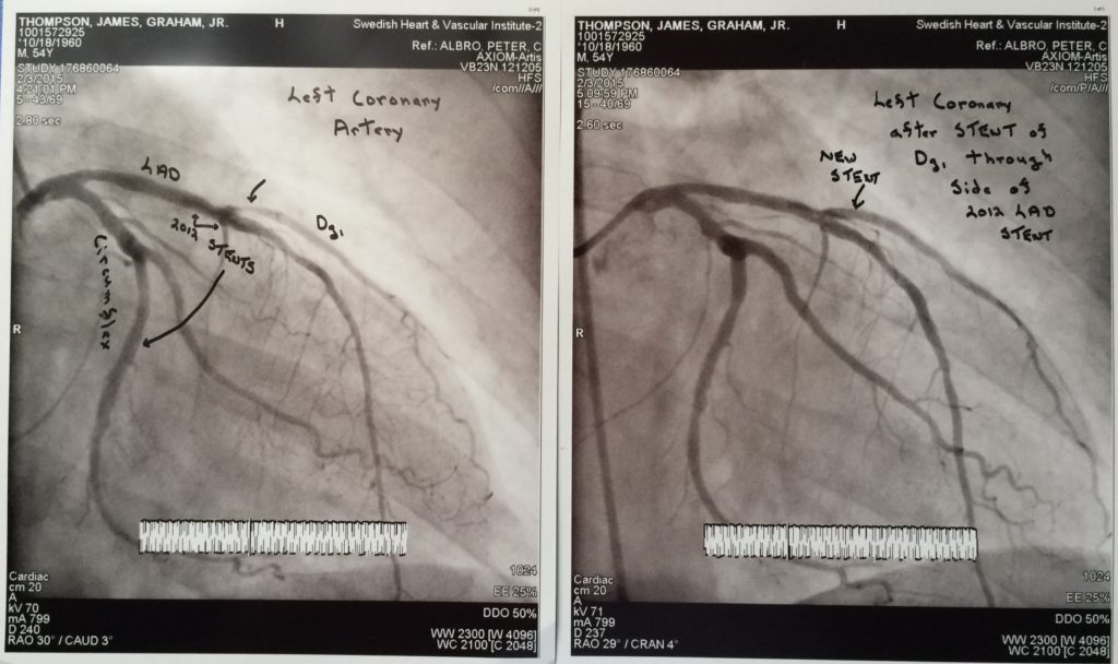 Feb stent before and after